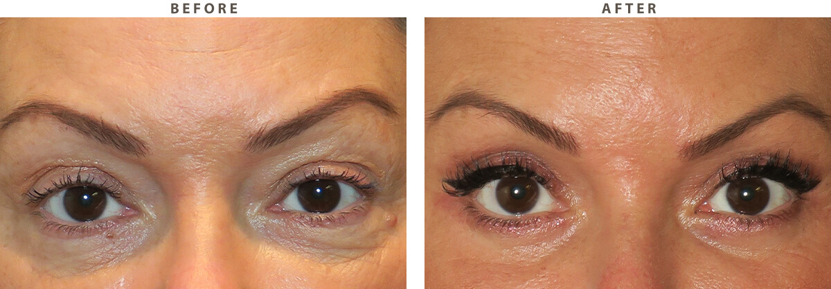 Eyelid lift - Before and After Pictures