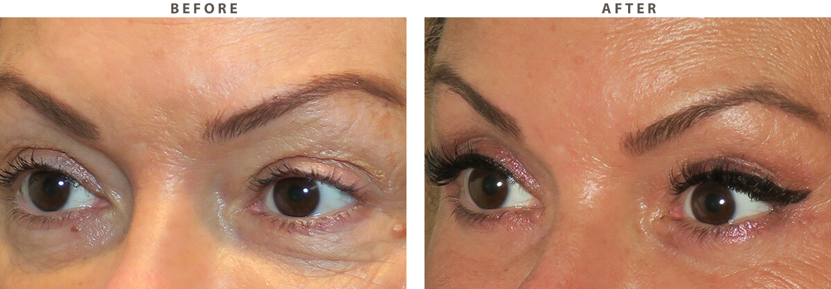 Eyelid lift - Before and After Pictures
