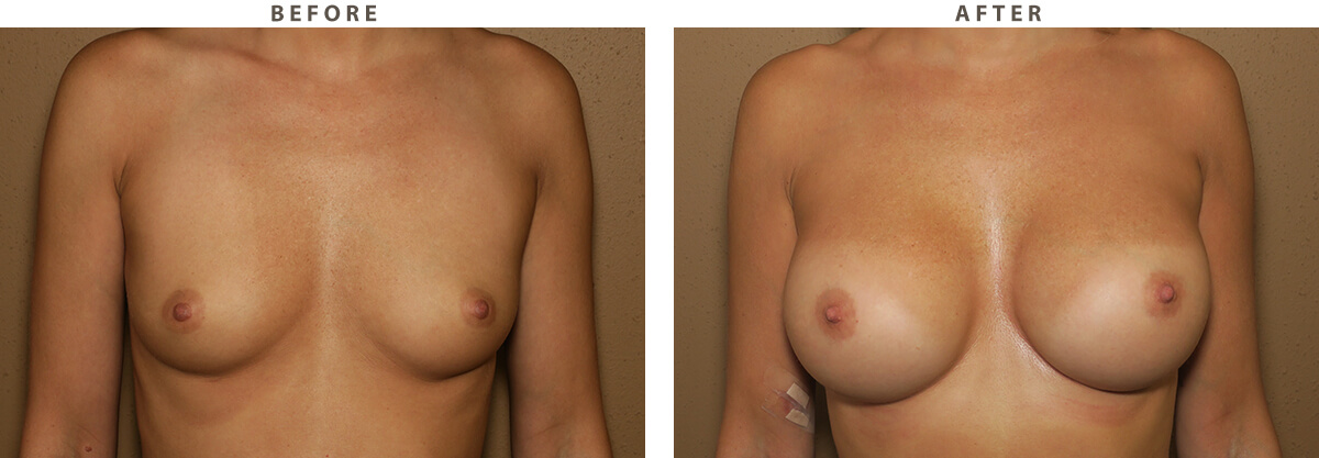 Breast Augmentation Chicago - Before and After Pictures