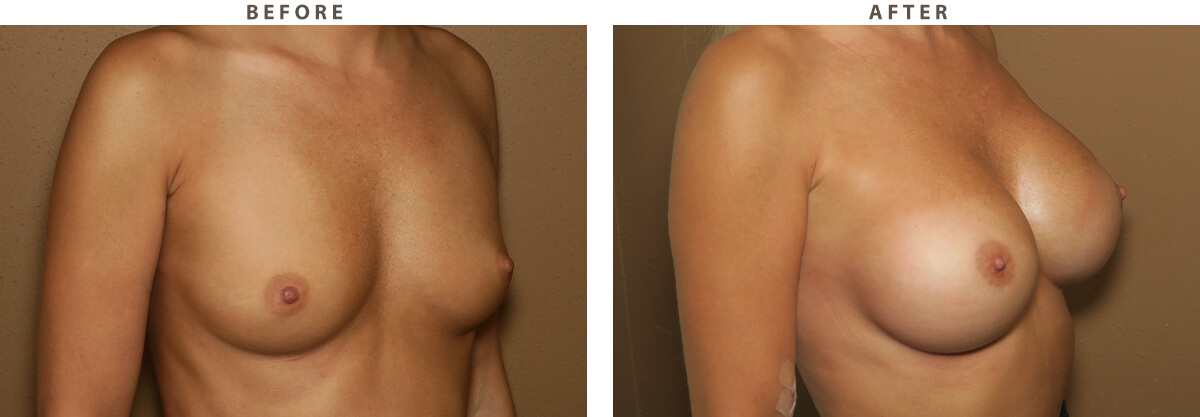 Breast Augmentation Chicago - Before and After Pictures