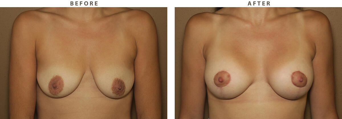 Breast Lift Chicago - Before and After Pictures