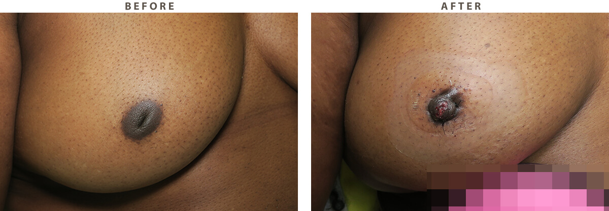 Inverted nipple correction Chicago - Before and After Pictures