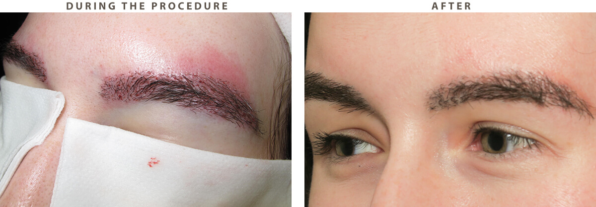 Eyebrow transplant - Before and After Pictures