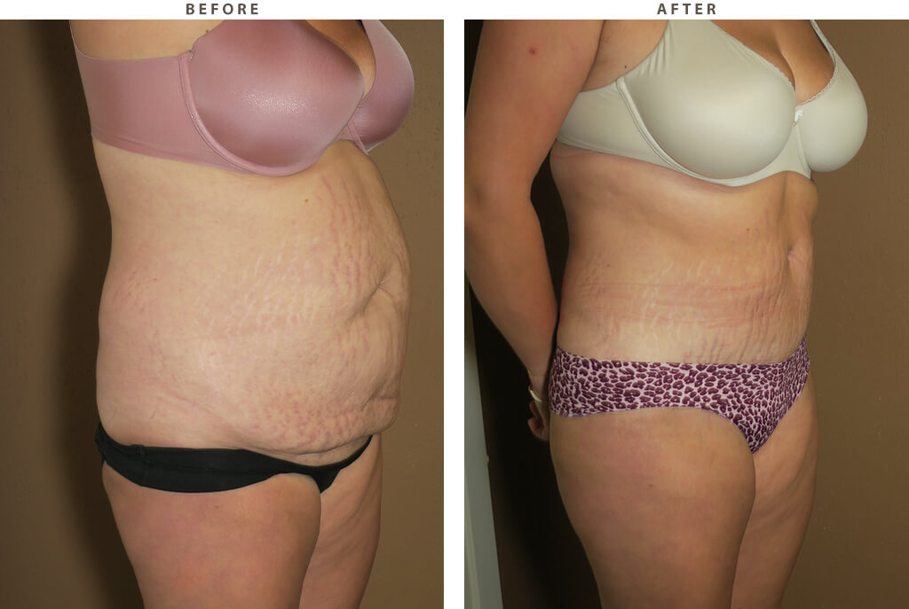 Abdominoplasty - Before and After Pictures