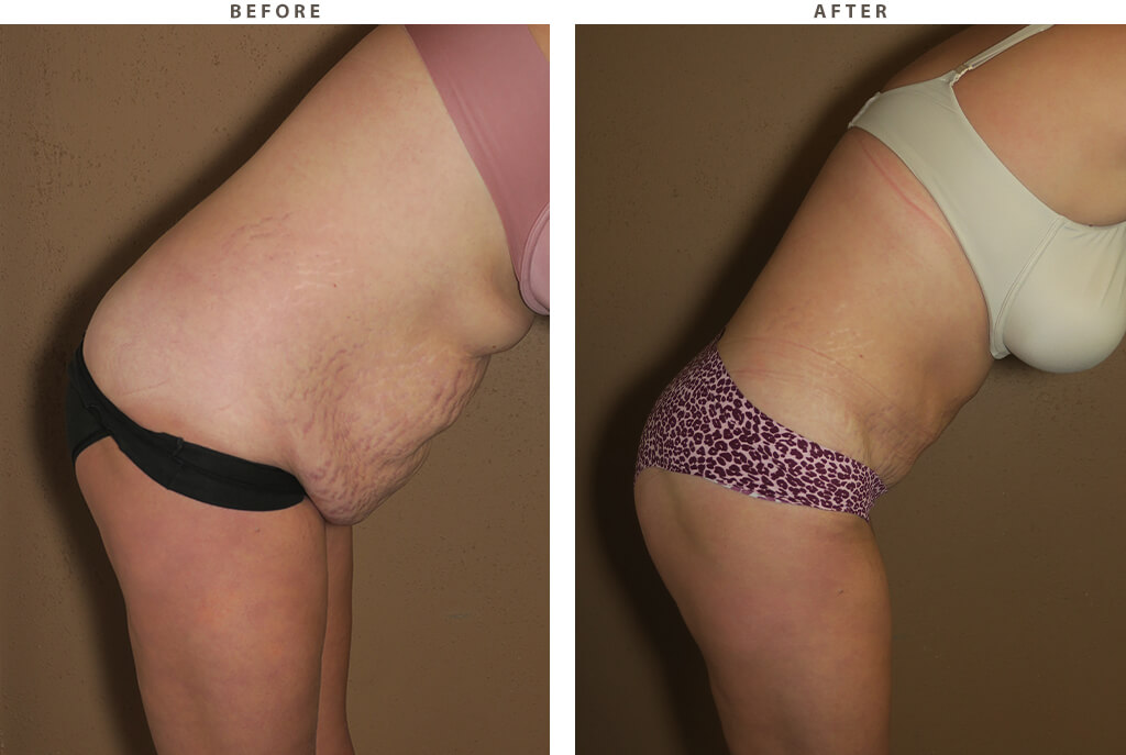 Abdominoplasty - Before and After Pictures