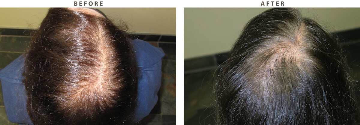 Hair transplant Chicago - Before and After Pictures