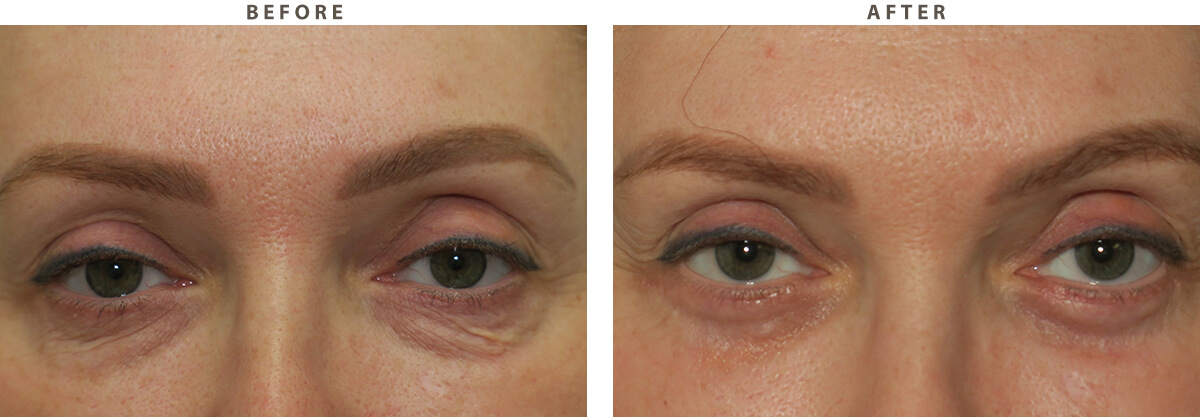 Blepharoplasty Chicago - Before and After Pictures