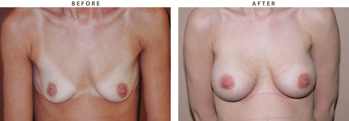 Breast augmentation Chicago - Before and After Pictures