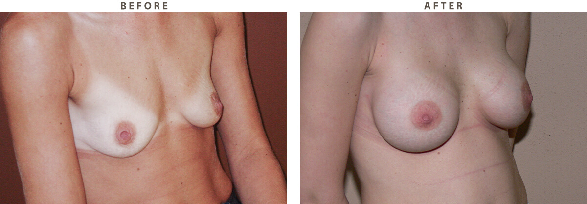 Breast augmentation Chicago - Before and After Pictures