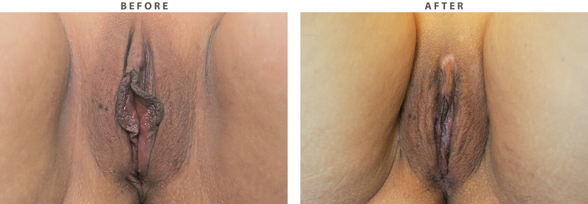 Labioplasty Chicago - Before and After Pictures