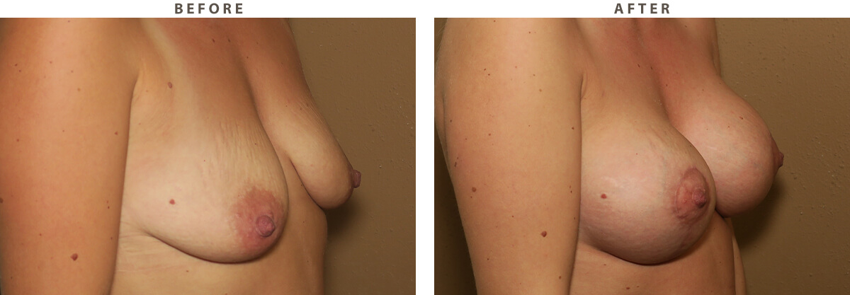 Mastopexy Chicago - Before and After Pictures
