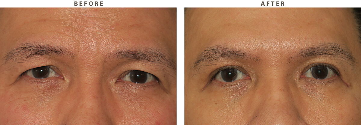 Upper blepharoplasty Chicago - Before and After Pictures