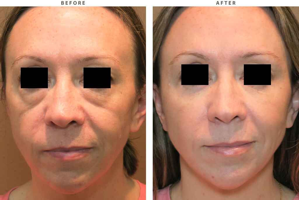 Facial rejuvenation Chicago - Before and After Pictures