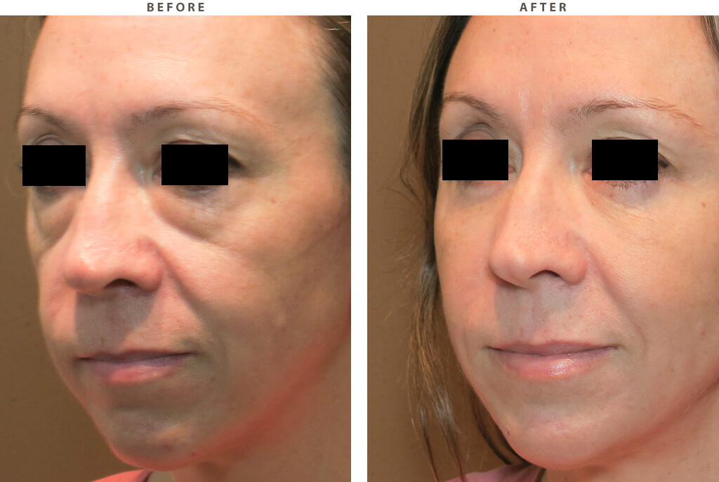 Facial rejuvenation Chicago - Before and After Pictures