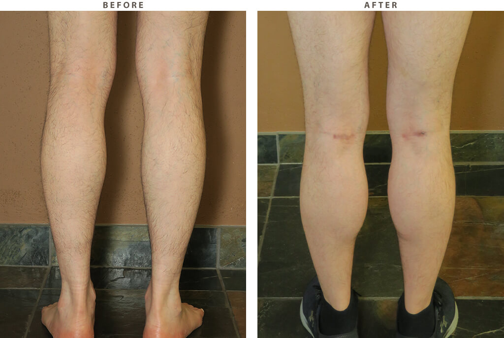 Calf implants Chicago - Before and After Pictures
