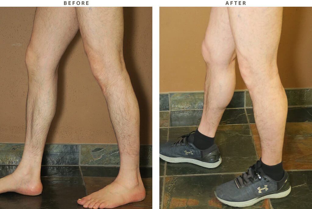 Calf implants Chicago - Before and After Pictures