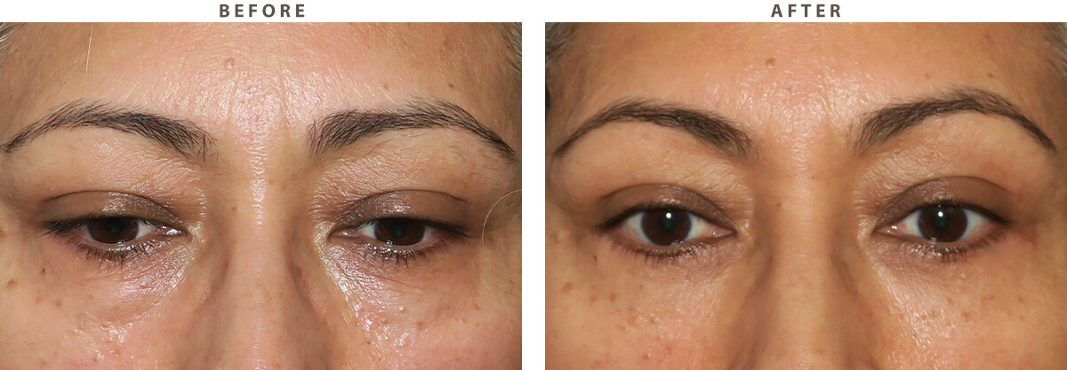 Lower blepharoplasty Chicago - Before and After Pictures