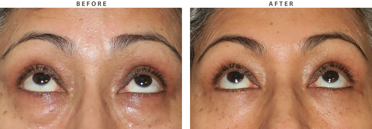 Lower blepharoplasty Chicago - Before and After Pictures