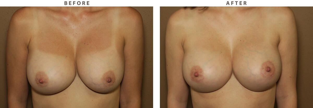 Revision breast augmentation Chicago - Before and After Pictures