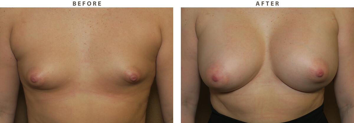 Tubular breasts correction Chicago - Before and After Pictures
