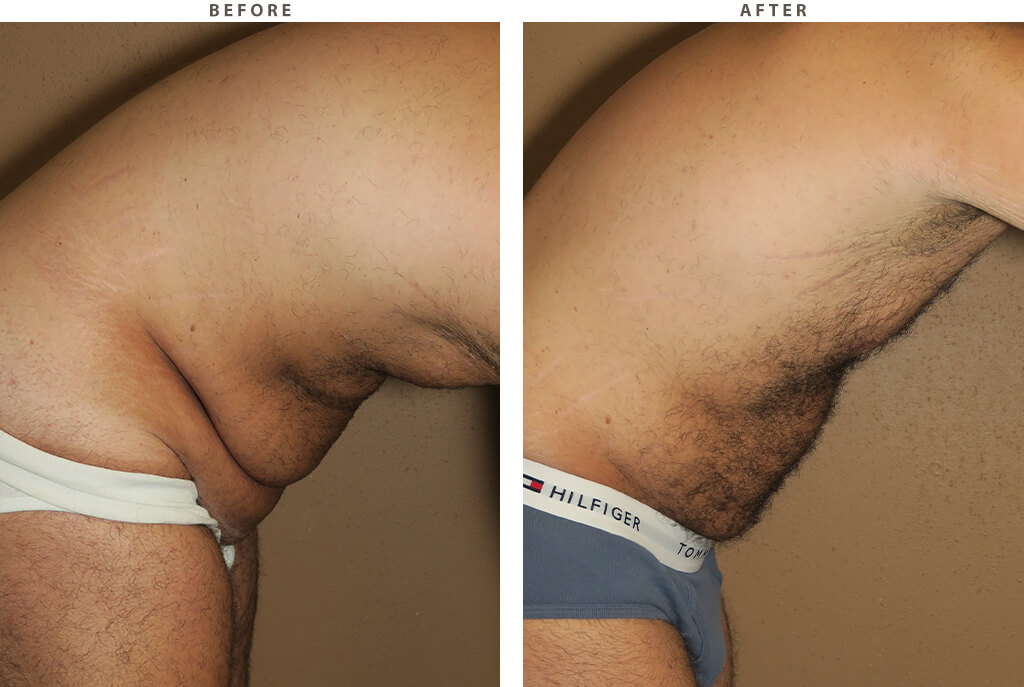 Abdominoplasty Chicago - Before and After Pictures