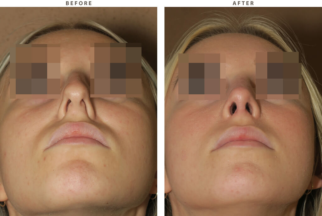 Rhinoplasty Chicago - Before and After Pictures