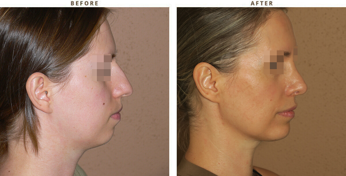 Chin augmentation - Before and After Pictures