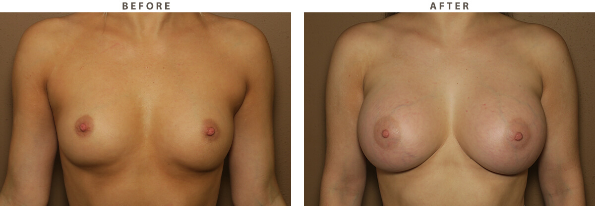 Breast augmentation - Before and After Pictures
