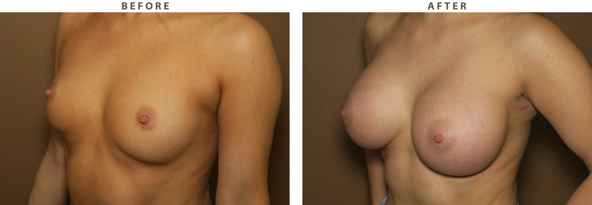 Breast augmentation - Before and After Pictures