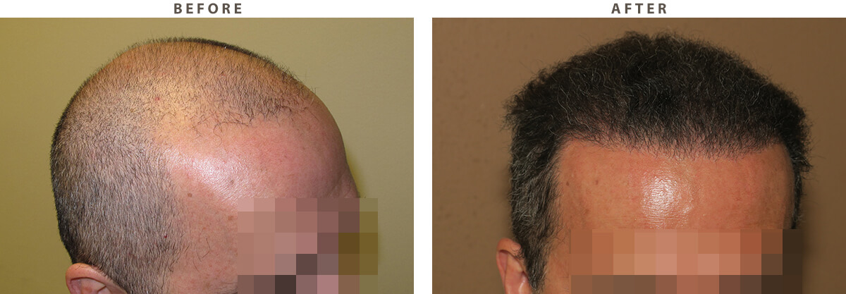 Artas - Before and After Pictures