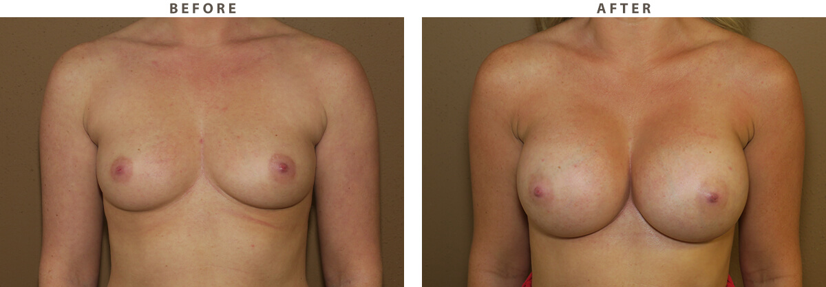 Endoscopic breast augmentation - Before and After Pictures