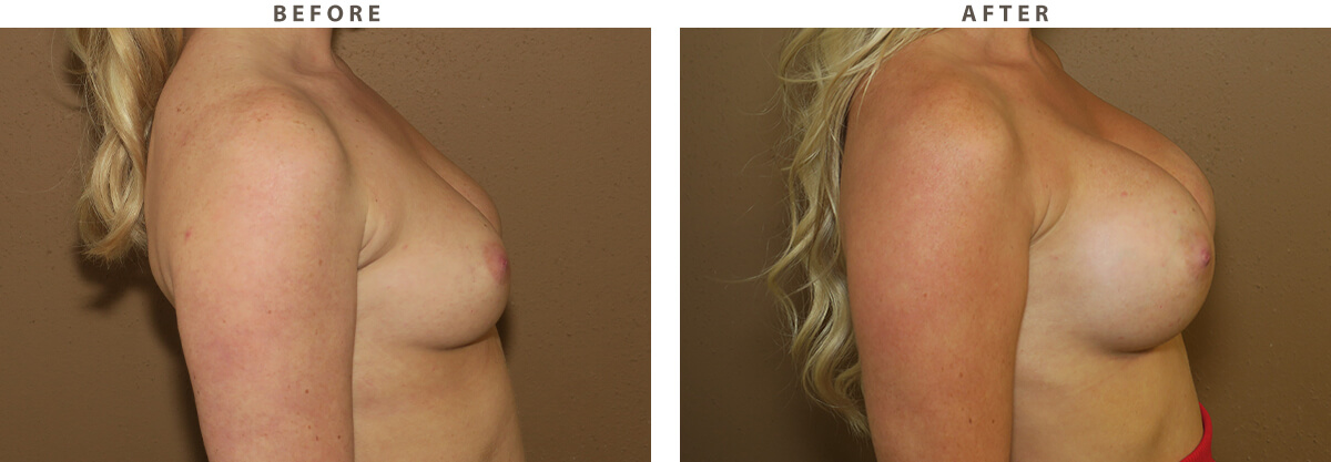 Endoscopic breast augmentation - Before and After Pictures