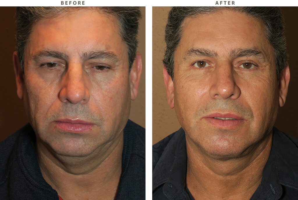 Male face lift - Before and After Pictures