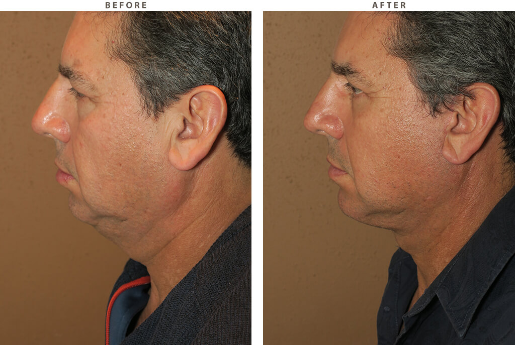 Male face lift - Before and After Pictures