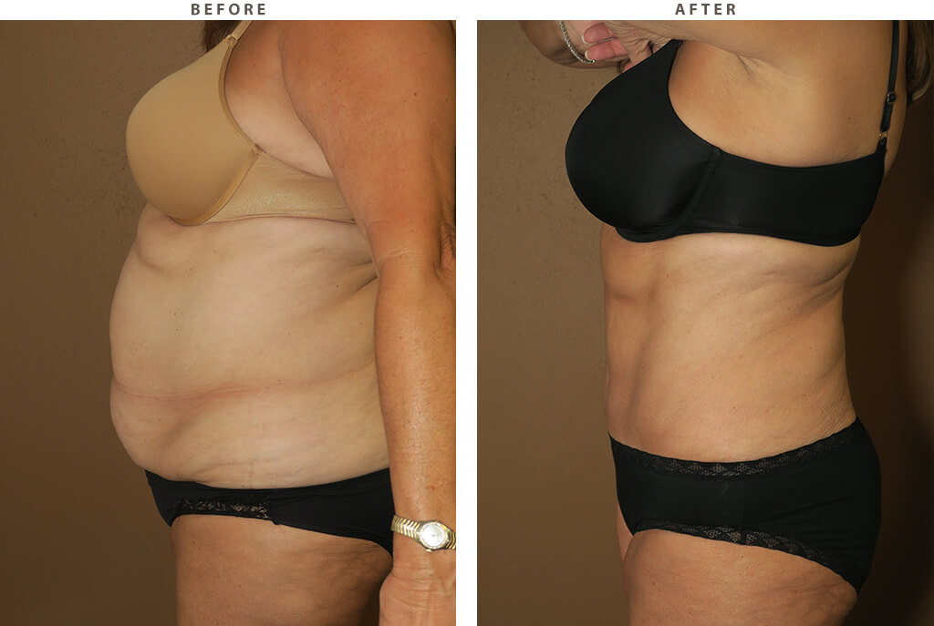 Tummy tuck - Before and After Pictures