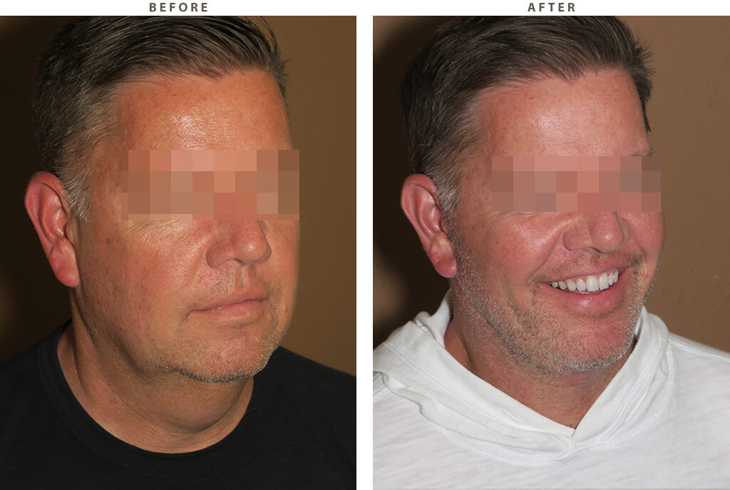 Face and neck lift - Before and After Pictures