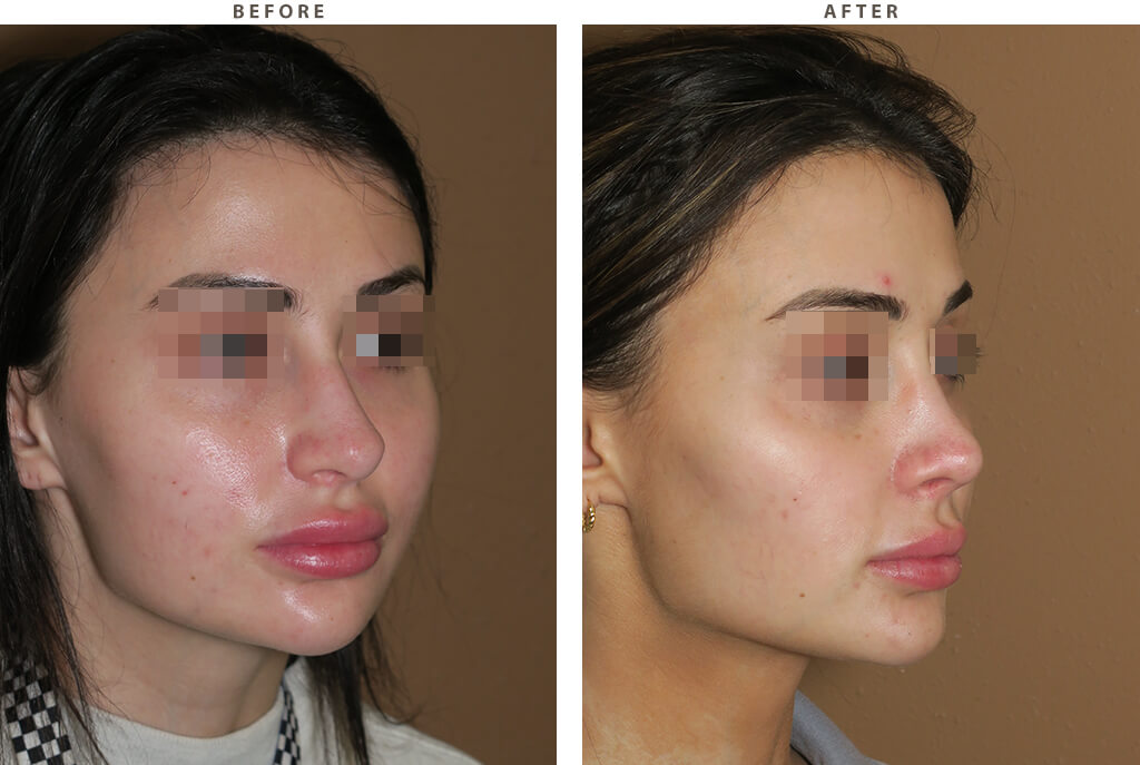 Revision rhinoplasty Chicago - Before and After Pictures