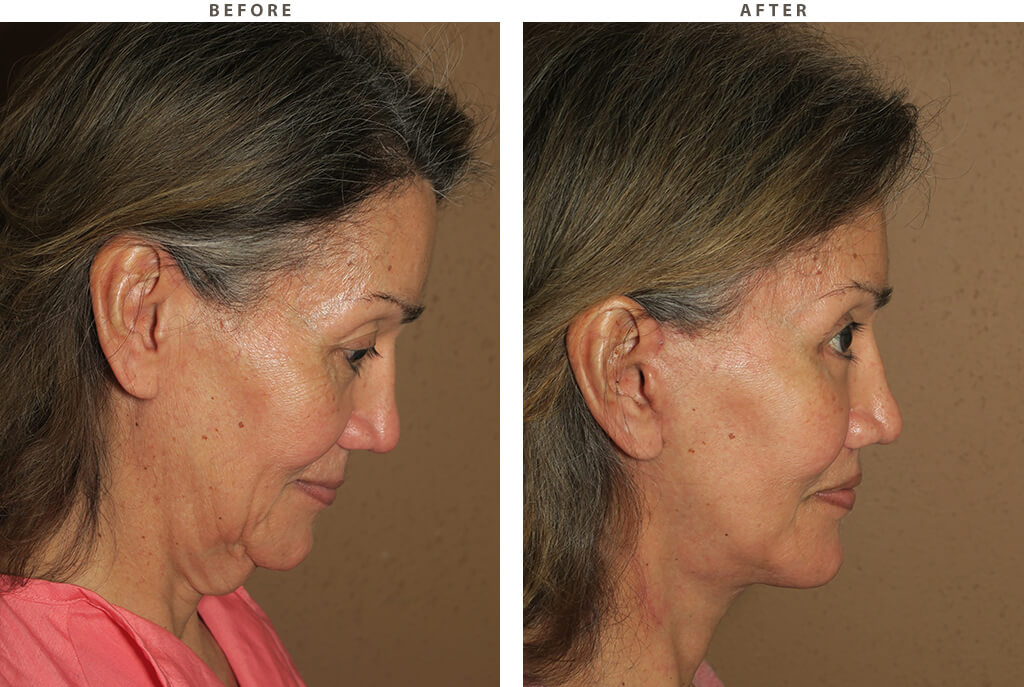 Complex Facial Rejuvenation Chicago - Before and After Pictures