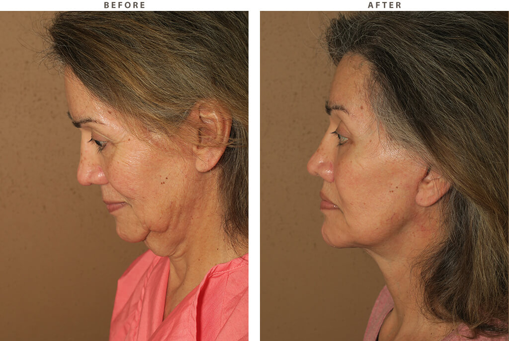 Complex Facial Rejuvenation Chicago - Before and After Pictures