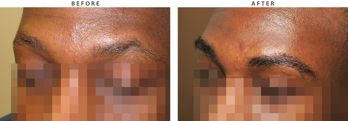 Brow transplant Chicago - Before and After Pictures