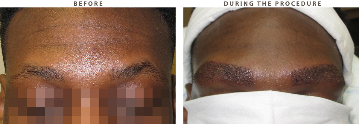 Brow transplant Chicago - Before and After Pictures
