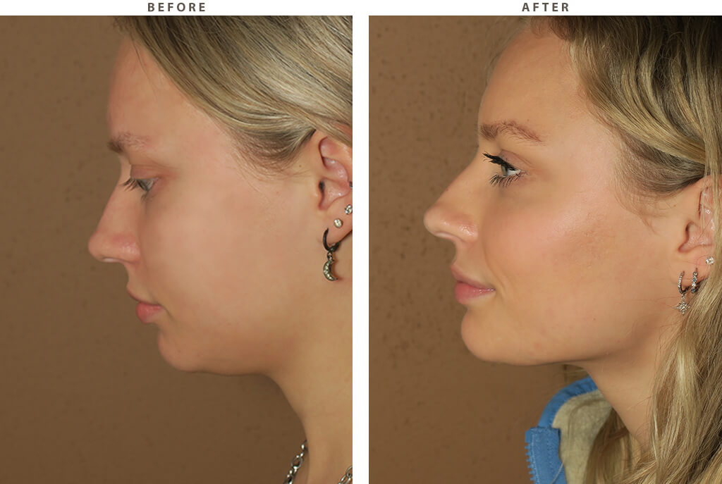 Neck lipo Chicago - Before and After Pictures