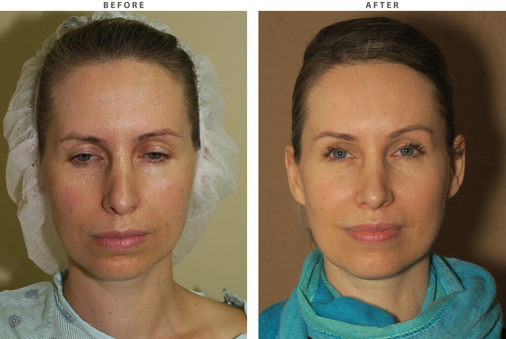 Mid Face Lift - Before and After Pictures