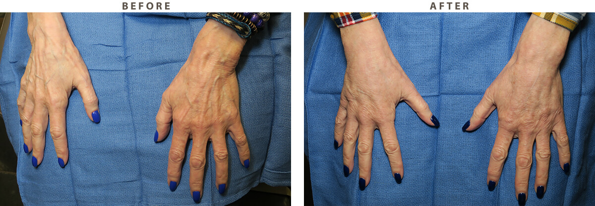 Hand Rejuvenation - Before and After Pictures
