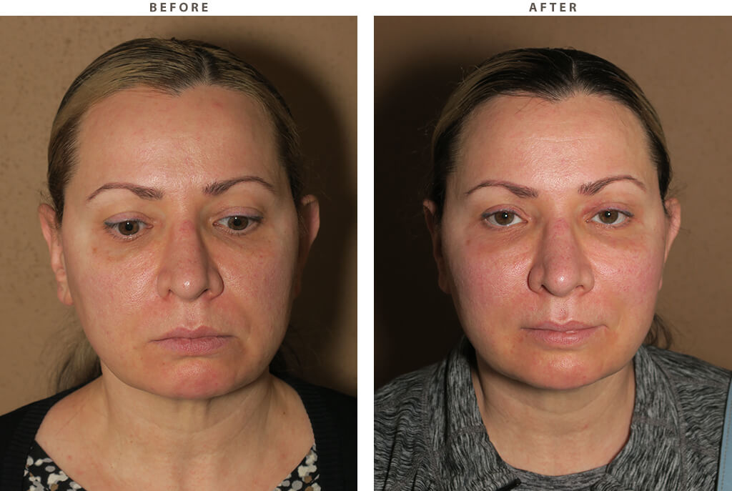 Mid facelift - Before and After Pictures