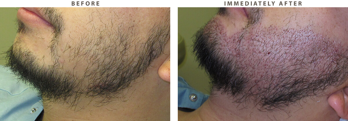 Facial Hair Transplant Chicago - Before and After Pictures