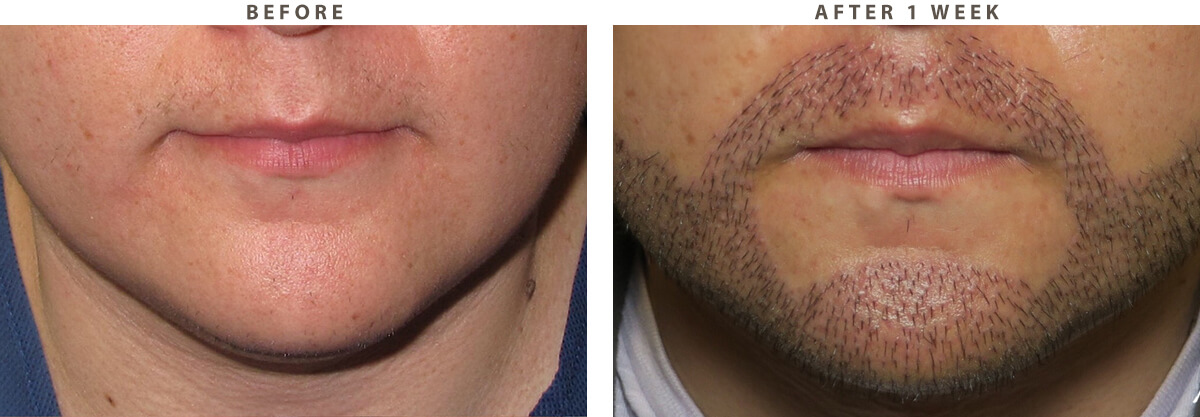 Facial Hair Transplant Chicago - Before and After Pictures