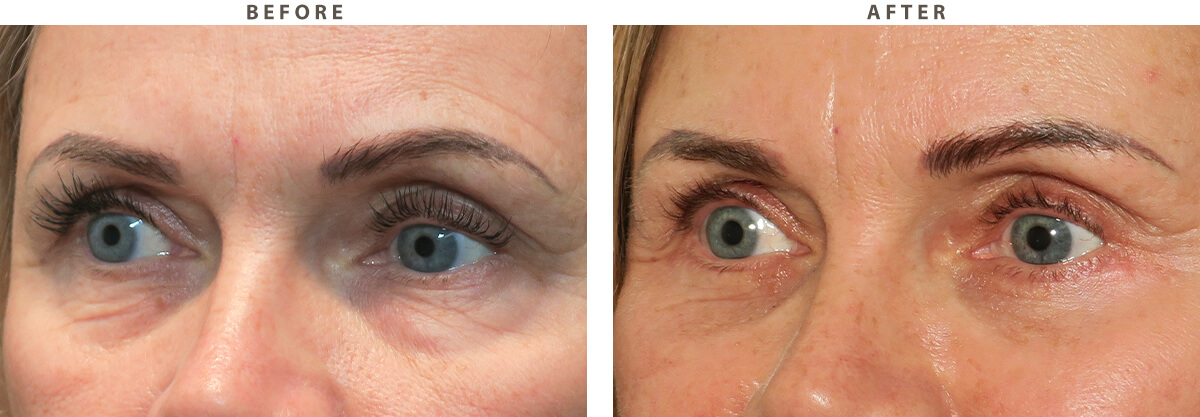 Blepharoplasty Chicago - Before and After Pictures