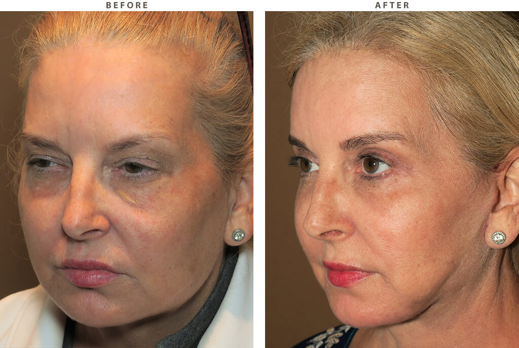 Facelift Chicago - Before and After Pictures