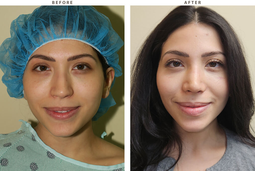 Rhinoplasty - Before and After Pictures